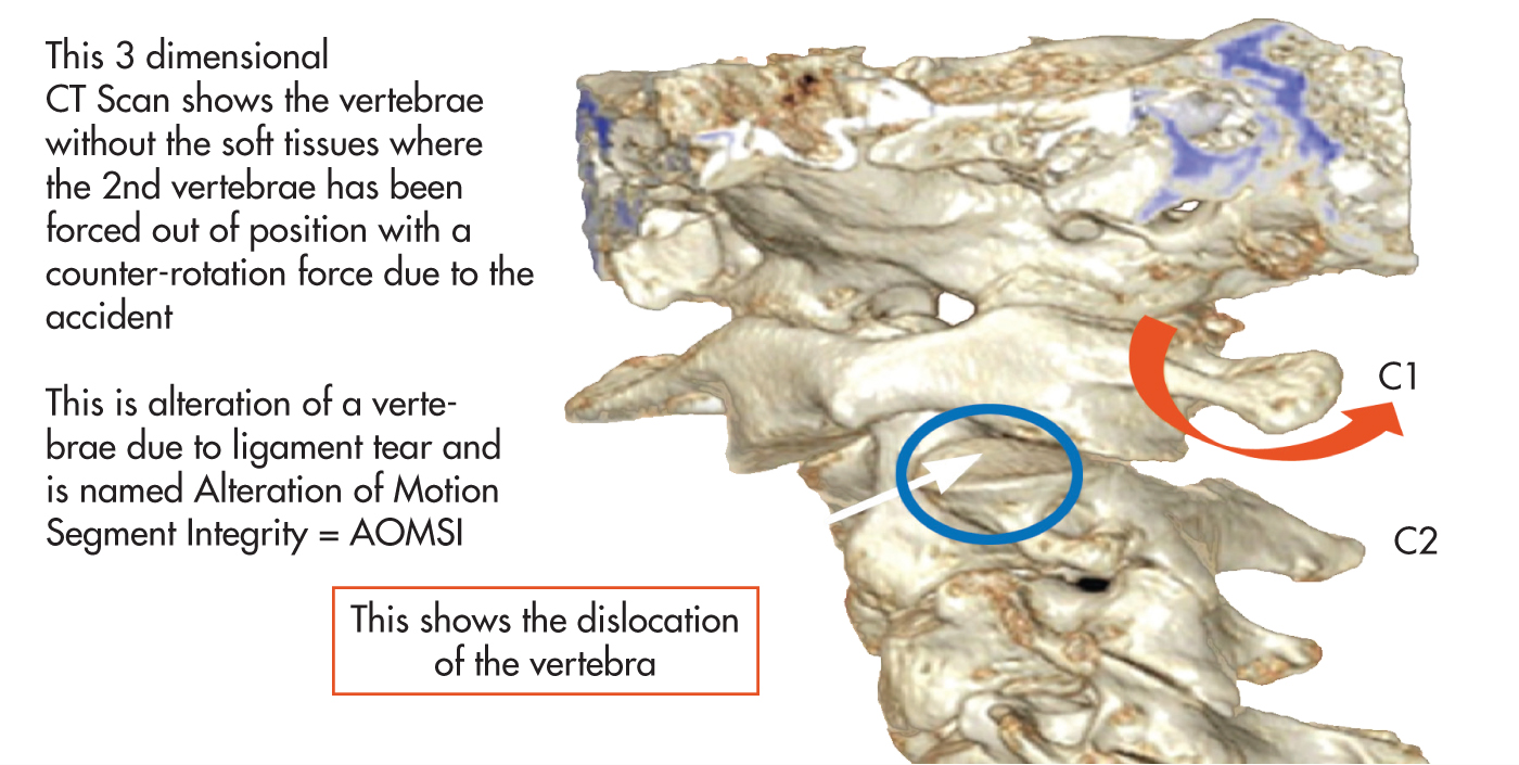 dislocation of vertebra
